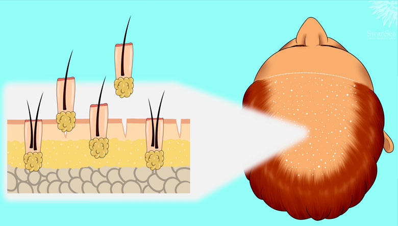 Microinjerto FUSS