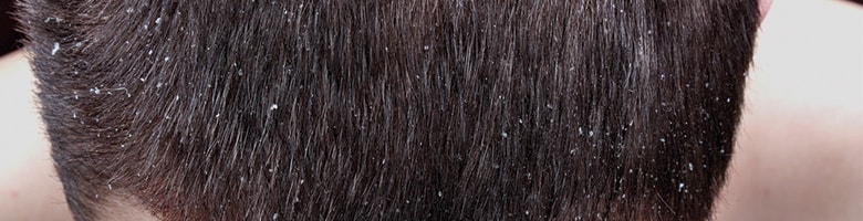 8-psoriasis-y-caida-del-cabello-min